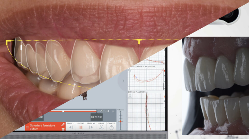 Smile Design, Wax-up numérique + Occlusion Dynamique | Mentora by French Tooth