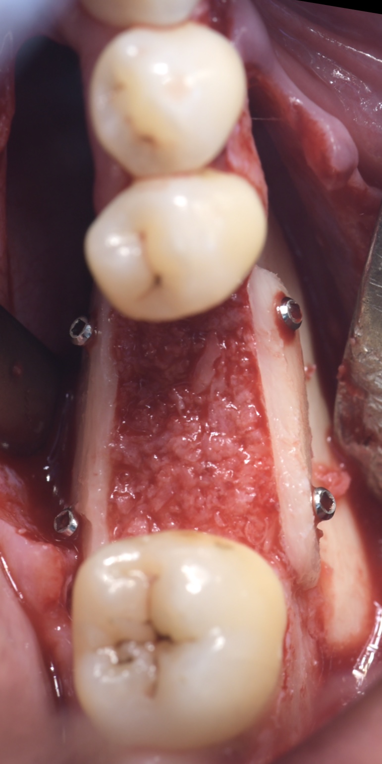 greffe osseuse autogène Mentora By French Tooth