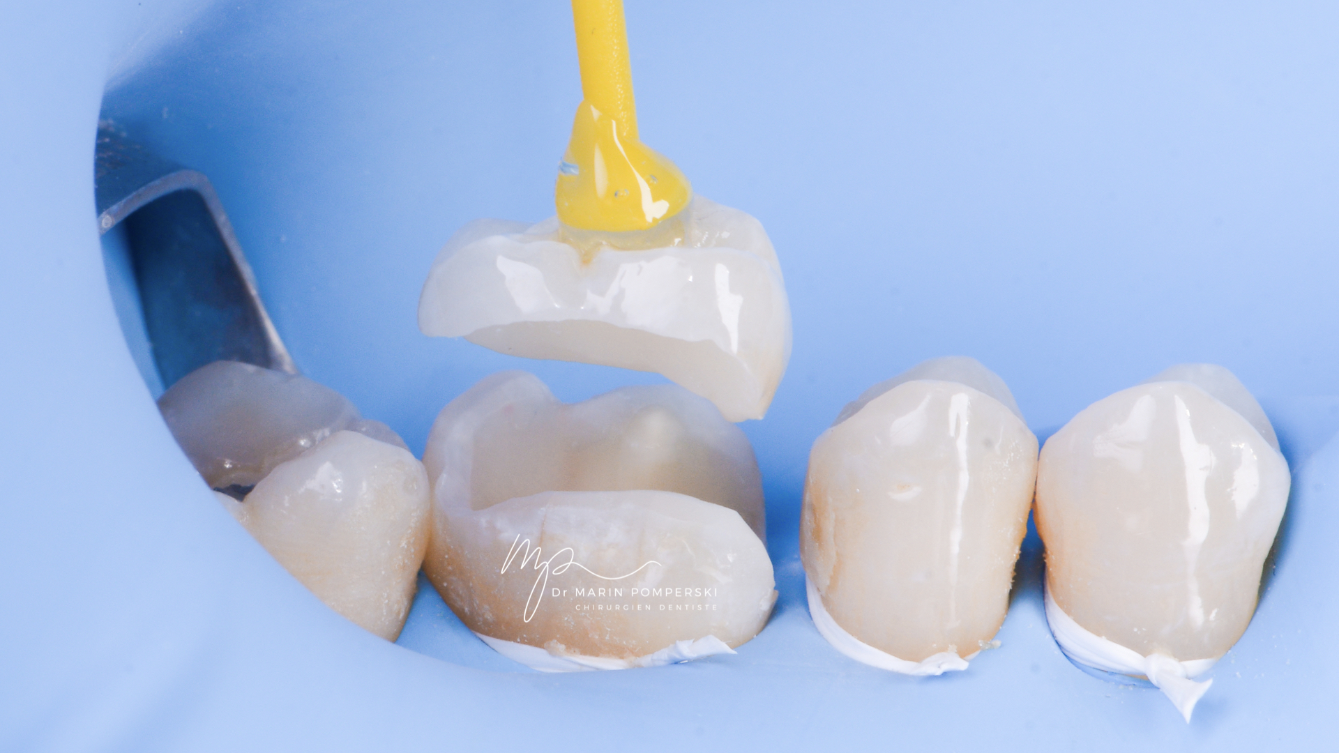 Inlay Onlay Overlay Mentora By French Tooth